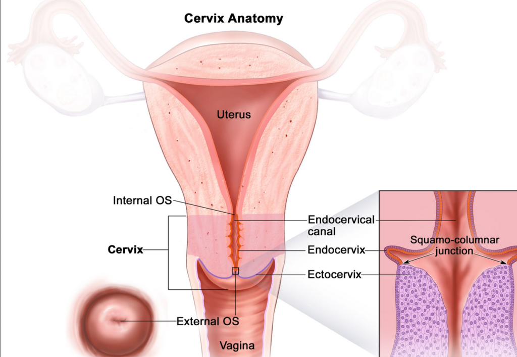 cervical cancer