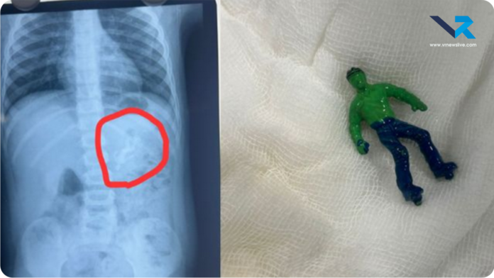 Child Swallowed Toy Hulk