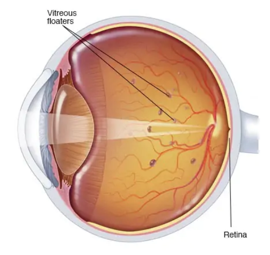 Eye Floaters