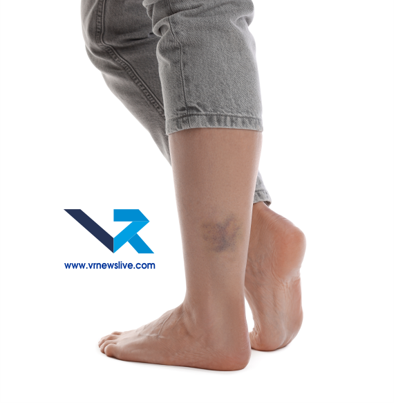 Heat Edema