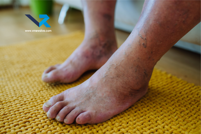 Heat Edema