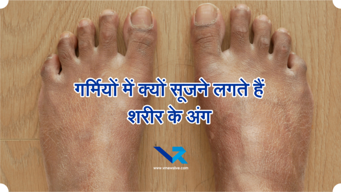 Heat Edema