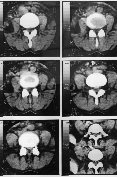 Prostate Cancer Research
