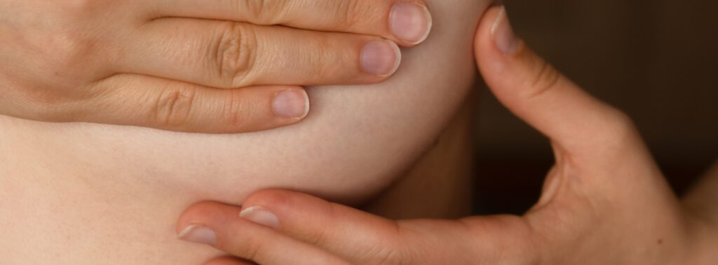 Under Breast Rashes